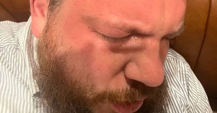 A.ナヴァルノ氏の同志がビリニュスで襲撃され重傷を負った：襲撃者は彼をハンマーで殴った