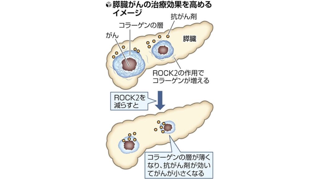 [ニュース] 「膵臓がん」抗がん剤効きにくい原因は、「細胞を取り巻く大量のコラーゲン」…岡山大などチーム発表