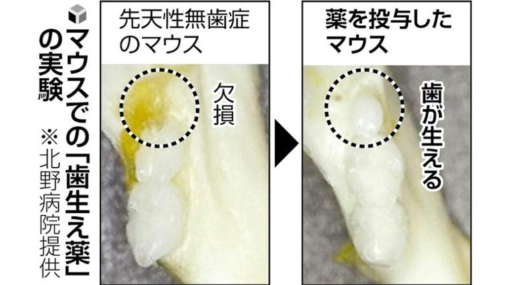 [#kyoto] 世界初の「歯生え薬」2030年の実用化目指す…京大病院などのチーム、９月から治験開始