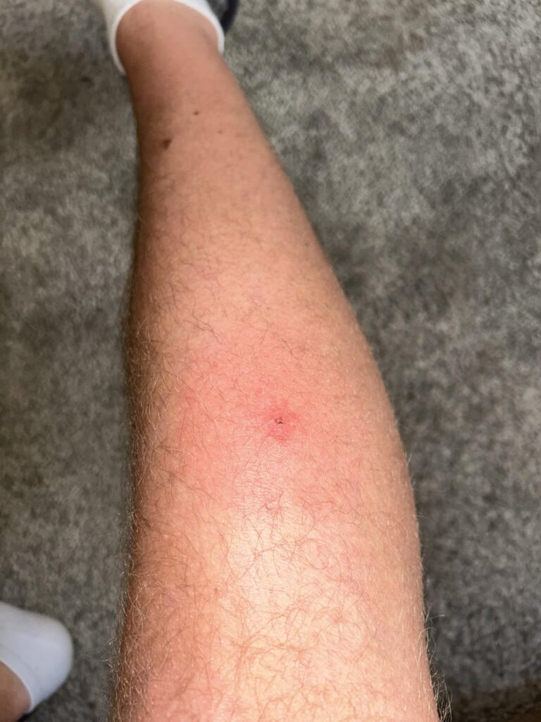 ダニ刺され