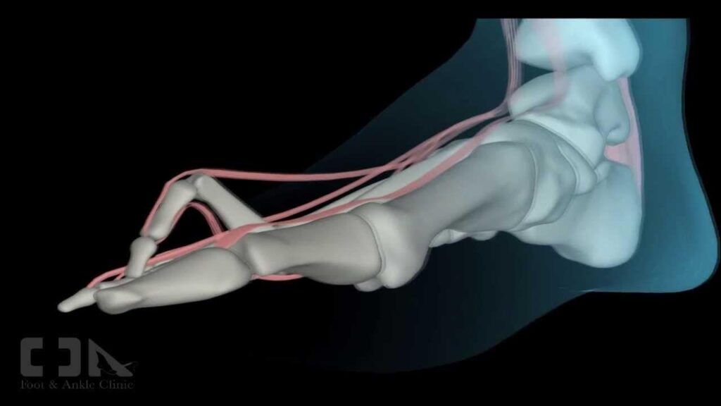 Hammer Toe Surgery - リスボン (優秀な外科医を探しています)