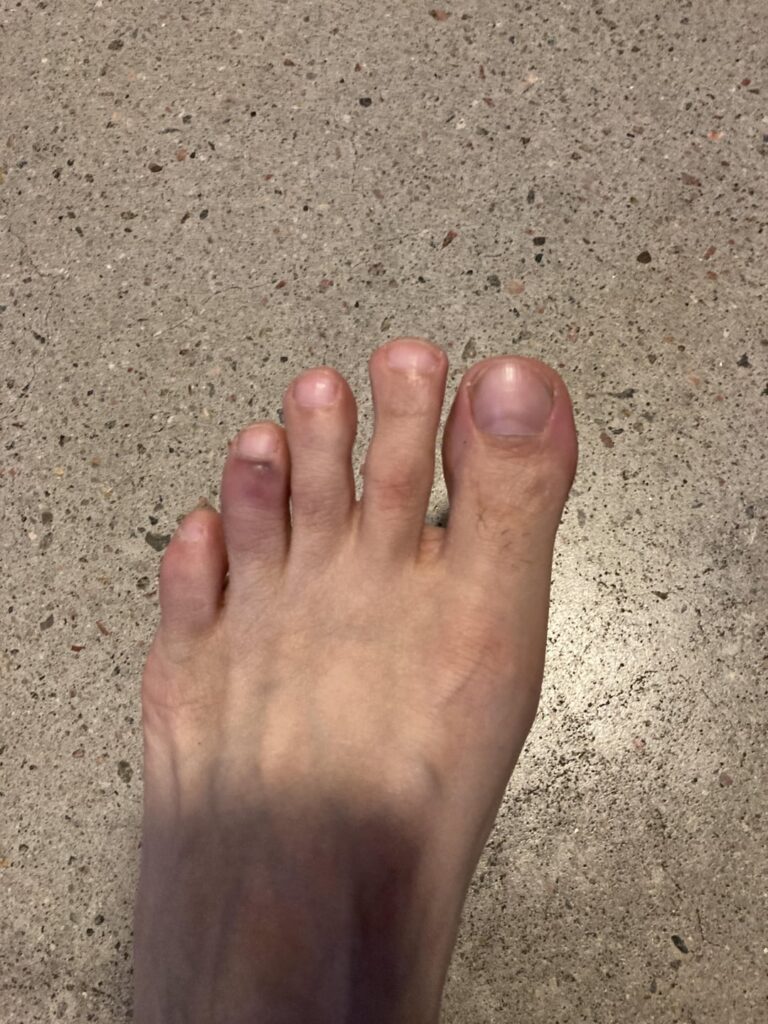 つま先を骨折した