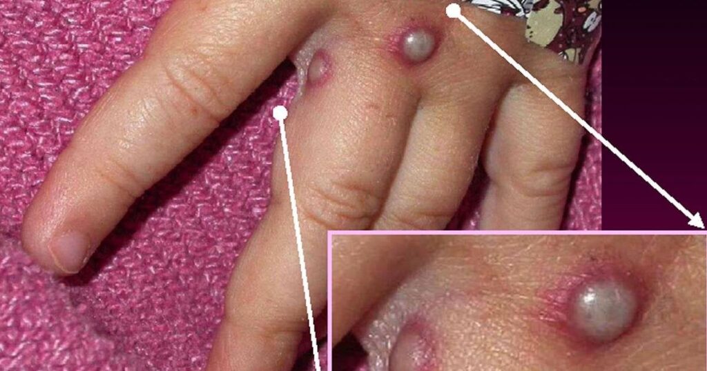サル痘、ヨーロッパにおけるクレード 1 変異種の最初の症例がスウェーデンで発生