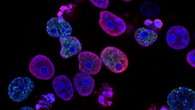 抗うつ薬は進行性脳腫瘍の治療に希望を与える | in.gr