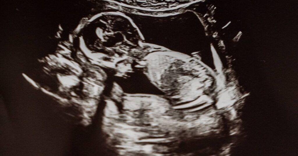 研究者らは、非自発的な子どもの不在の主な原因を発見した可能性がある