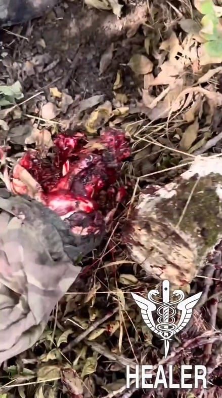 PFM-1対人地雷で足を失ったロシア軍人の別の映像。カメラマンが切り株とその周囲にある2つの地雷を撮影している（画像）