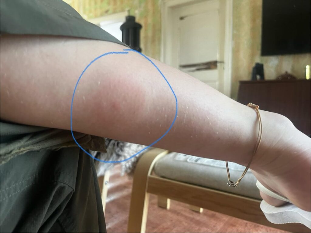 ライム病をどれくらい怖がるべきでしょうか?