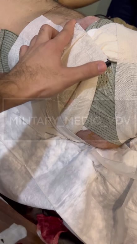 ロシア兵は手術の前後で右腰の部分に非常に生々しい傷を負ったが、情報筋はそれがウクライナ戦車の仕業だったと述べている