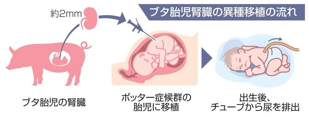 慈恵医大、ブタ腎臓の重症胎児への移植申請 - 実現すれば国内初