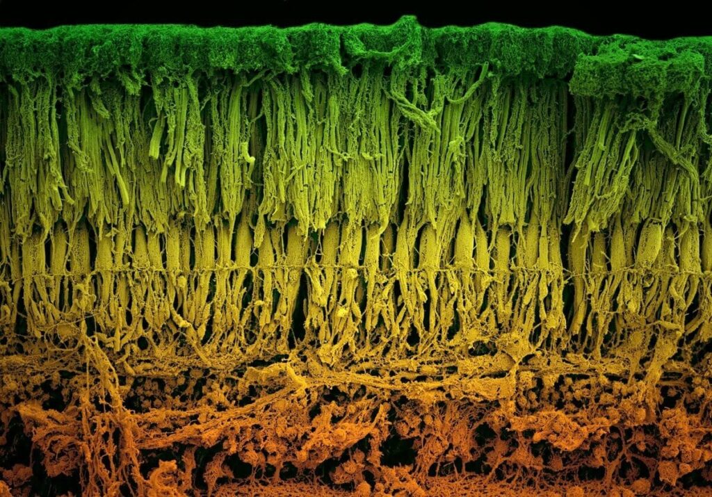 視力を失っていく不治の病、網膜色素変性症とは、なりやすい人は