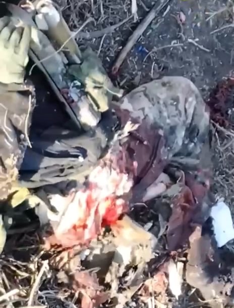 負傷したロシア兵は体の一部を失った。警告ビデオは非常に生々しいです！