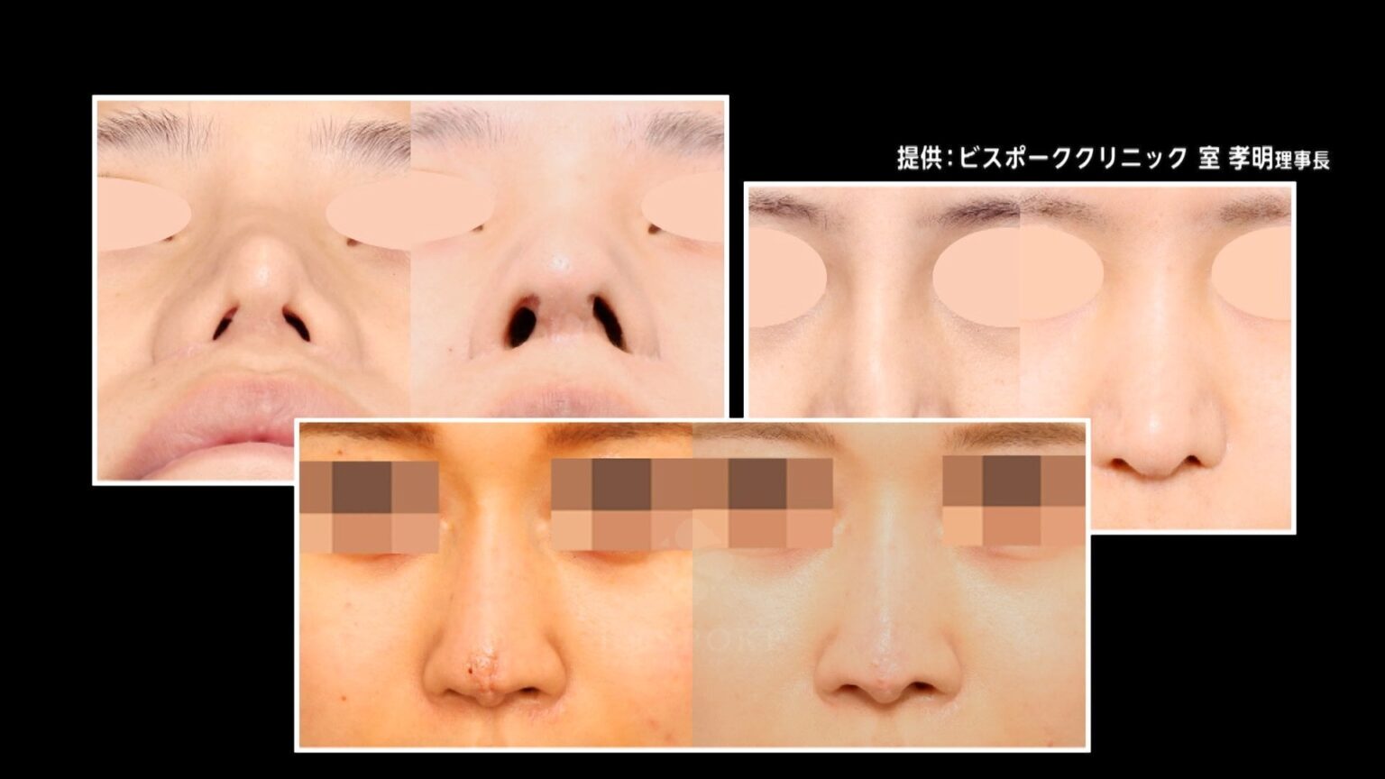 【にしこり】「こめかみにしこりが…」美容医療トラブルが急増する背景とは?“直美（ちょくび）”の医師が増加でベテラン医師による“教育サービス”の取り組みも