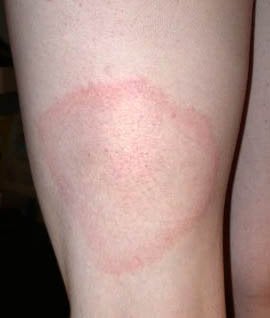 ライムのような皮膚発疹