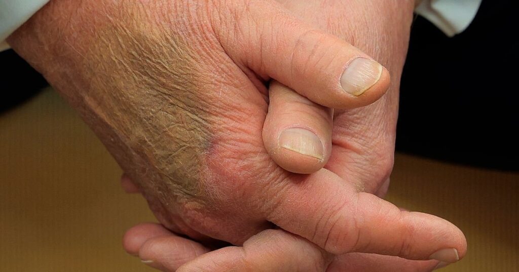 78歳のトランプは、手元に不思議な大きな打撲傷を示しています