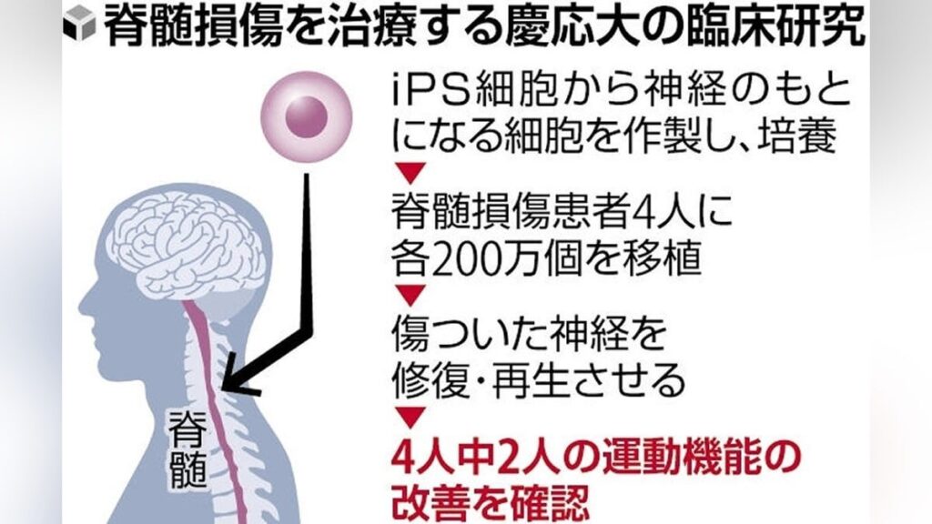 ｉＰＳ細胞移植後に２人の運動機能が改善、脊髄損傷患者が自分で食事をとれるように…世界初