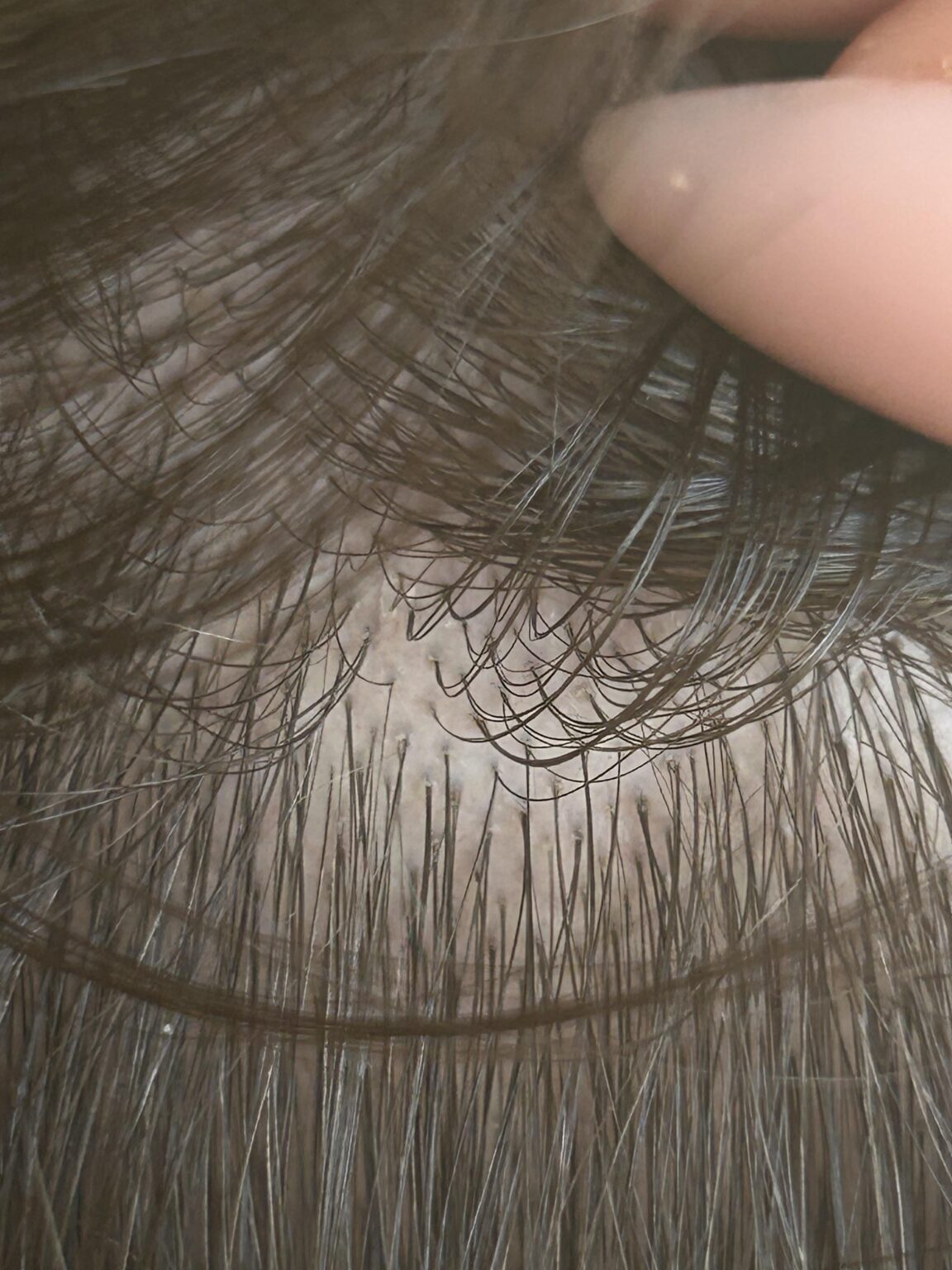 私の夫は、一つの毛穴から二重三重に毛が生えています