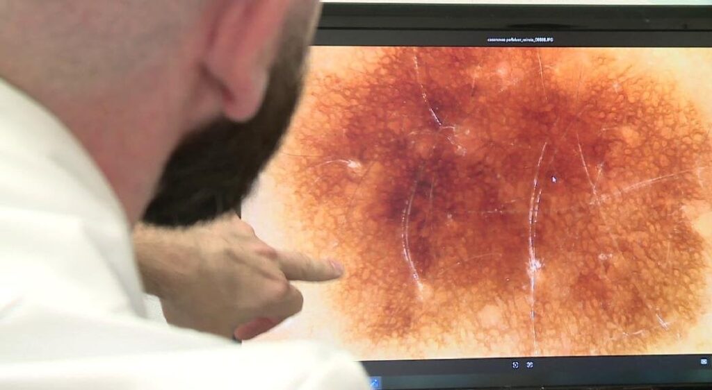 アンドラの高度は、皮膚がんのリスクを高めます
