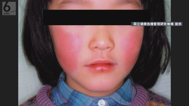「リンゴ病」大阪府で初の警報基準超え　定点あたりの患者数が１週間２．１４人で過去最多　奈良でも２４年ぶりの水準