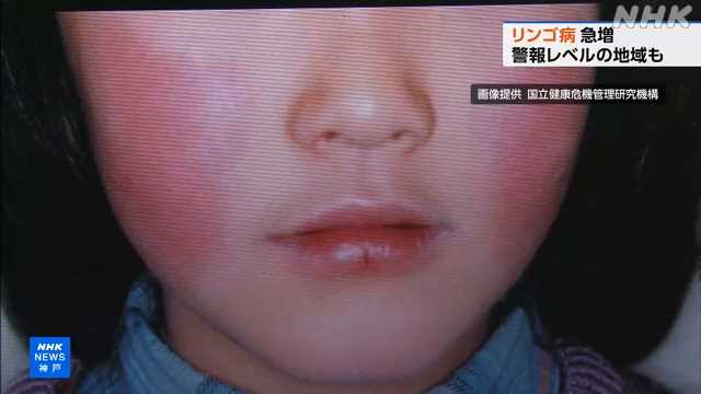 リンゴ病 県内で急増 神戸市などで警報レベル 兵庫｜NHK 兵庫県のニュース