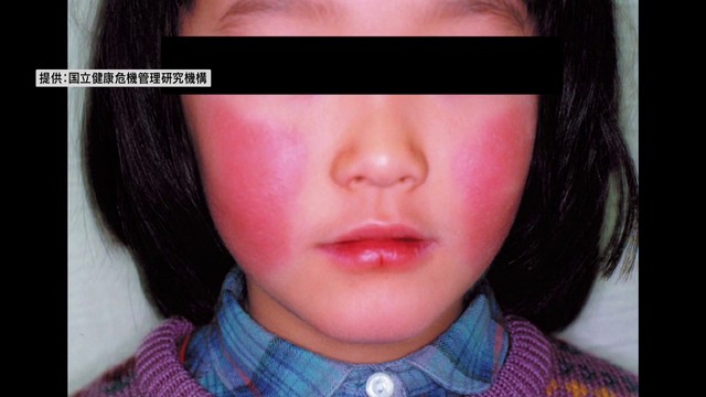「リンゴ病」新たに峡東保健所管内で警報レベル入り 県内患者は8週連続で増加 山梨（YBS山梨放送） - Yahoo!ニュース