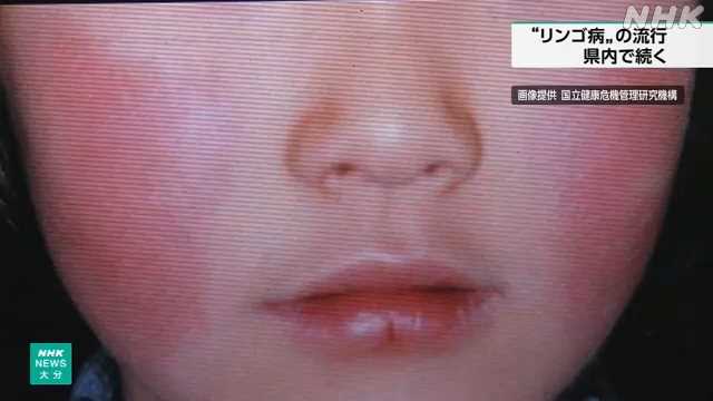 リンゴ病 大分県内でも流行続く “手洗いやマスク着用を”|NHK 大分県のニュース リンゴ病 大分県内でも流行続く “手洗いやマスク着用を”|NHK 大分県のニュース