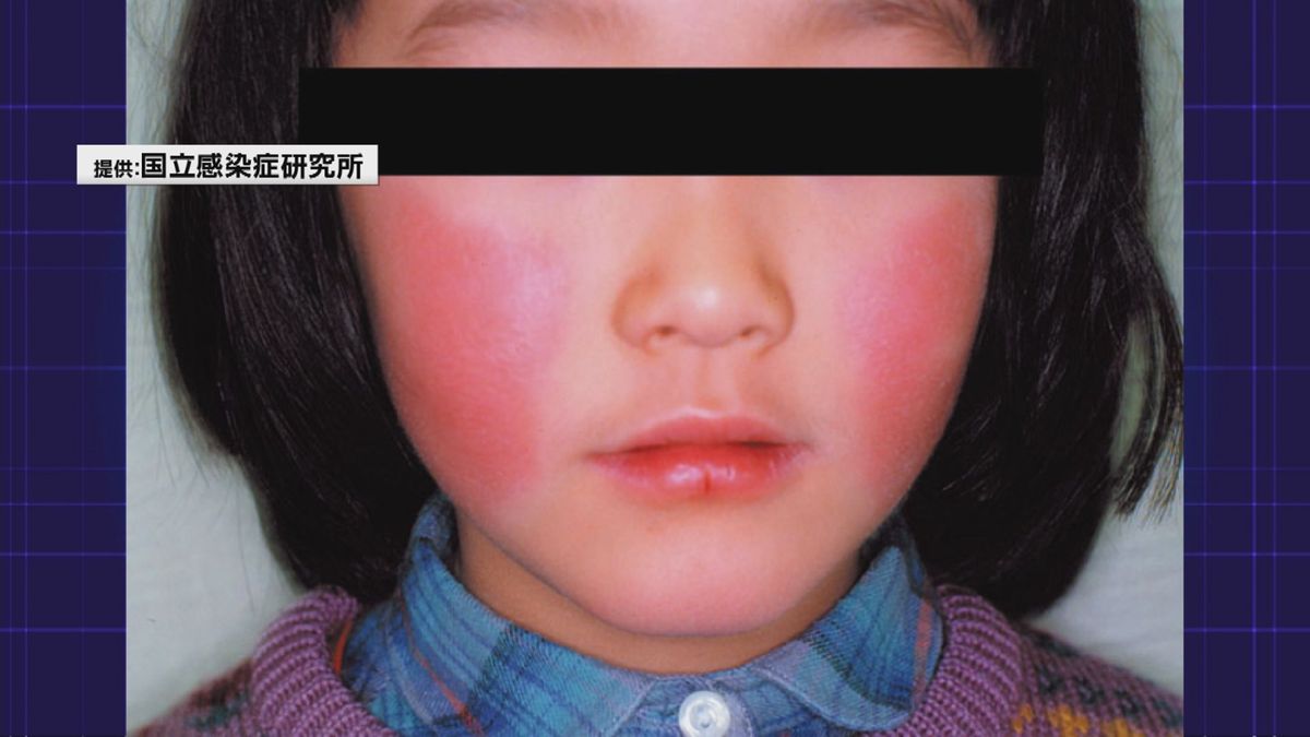 山形県内　「百日咳」1週間の感染患者報告数が過去最多　「リンゴ病」9週連続警報レベル