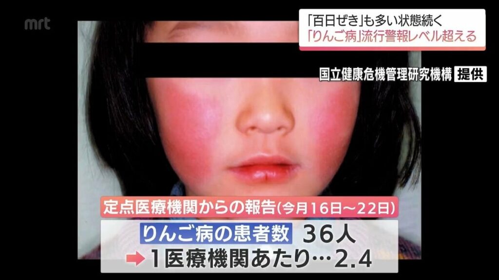 子どもに多い感染症「りんご病」 宮崎県内で14年ぶりに流行警報レベル超える 「百日ぜき」の患者数も過去最多に | MRTニュース ｜ ＭＲＴ宮崎放送 - TBS NEWS DIG