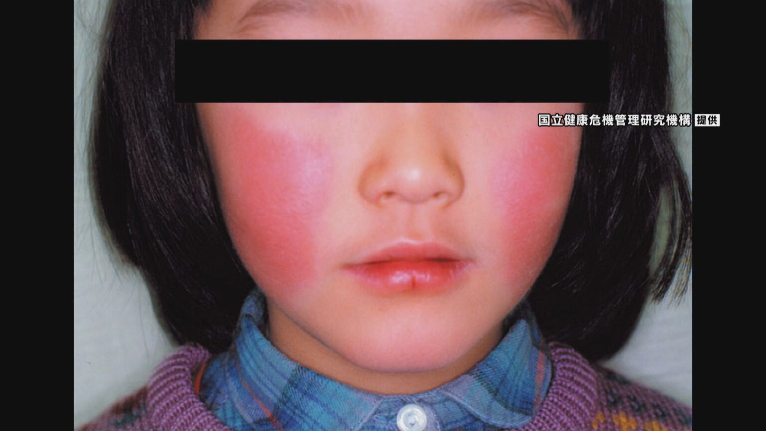 こども中心に流行の「りんご病」 愛知県で患者数が警報レベル超える 妊婦は感染で流産の恐れも 県が感染対策を呼びかけ（CBCテレビ） - Yahoo!ニュース
