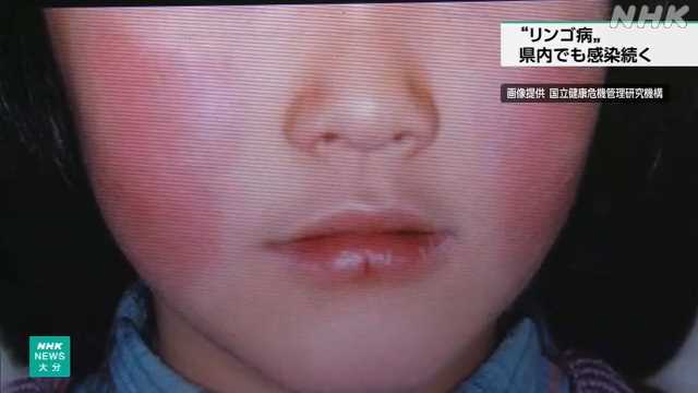 「リンゴ病」 大分県内でも感染が拡大 手洗いやマスク着用を｜NHK 大分県のニュース