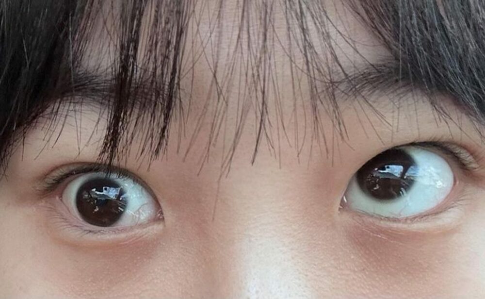 整形手術後に斜視発症…韓国・副作用を訴えた女性に“名誉毀損”で病院が反撃　写真枚　国際ニュース：AFPBB News