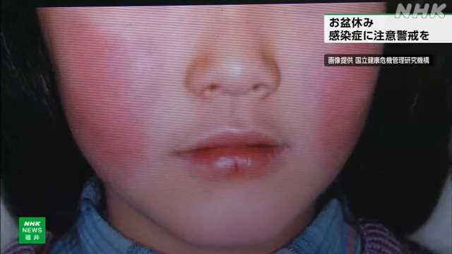 「りんご病 」「百日せき」など感染症に注意警戒を 福井|NHK 福井県のニュース 「りんご病 」「百日せき」など感染症に注意警戒を 福井|NHK 福井県のニュース