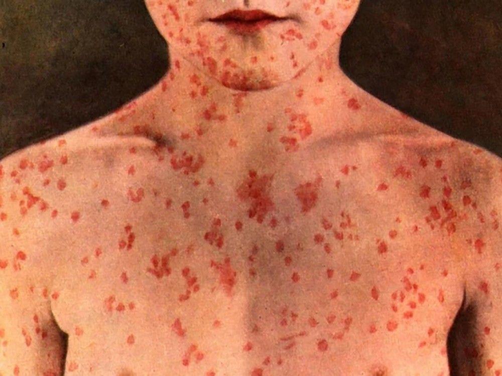 カナダは10月までに麻疹の排除指定を失う可能性があります：専門家
