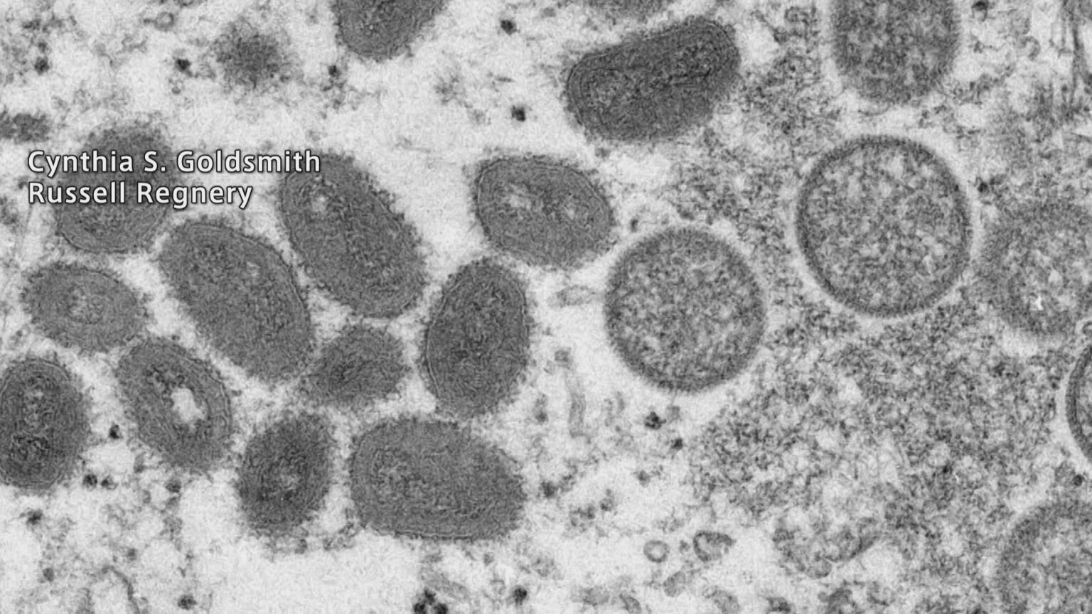 エムポックス重症型が日本国内で初確認 アフリカに渡航歴ある20代女性 厚生労働省（TBS NEWS DIG Powered by JNN） - Yahoo!ニュース