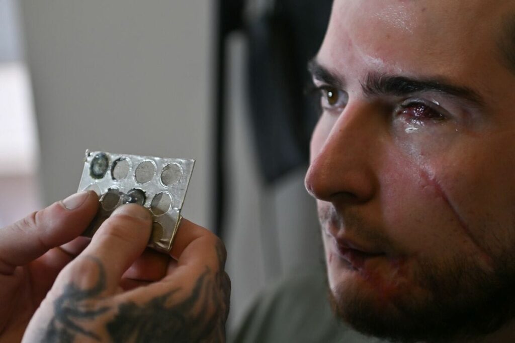 【ウクライナ密着取材】戦争で目や鼻、耳、あごを失った兵士たちはどんなサポートを受けているのか 【写真ルポ】義足やPTSD対策だけじゃない、顔に大きな傷を負った兵士の支援プログラムが救うもの(1/4) | JBpress (ジェイビープレス) 【ウクライナ密着取材】戦争で目や鼻、耳、あごを失った兵士たちはどんなサポートを受けているのか 【写真ルポ】義足やPTSD対策だけじゃない、顔に大きな傷を負った兵士の支援プログラムが救うもの(1/4) | JBpress (ジェイビープレス)