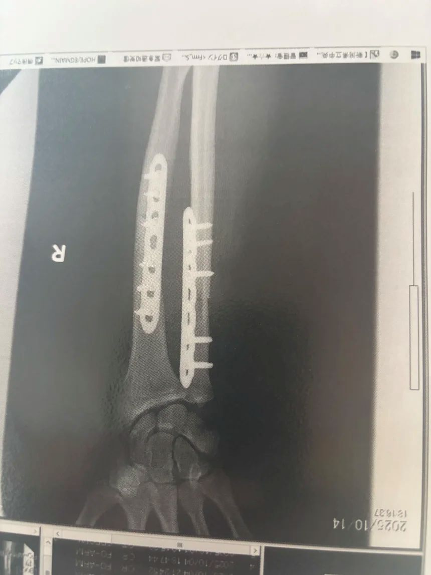 クマに噛まれた箇所に金属プレートを挿入したハロランさんの腕のレントゲン写真/Billy Halloran