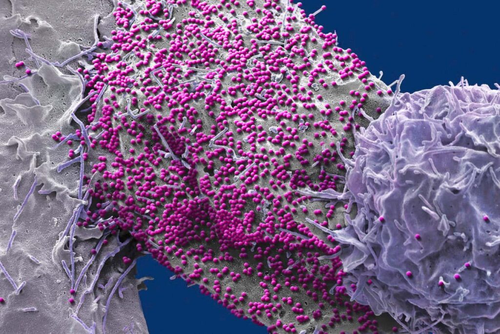 非HIV耐性幹細胞の移植を受けた男性が予期せずHIVから治癒した