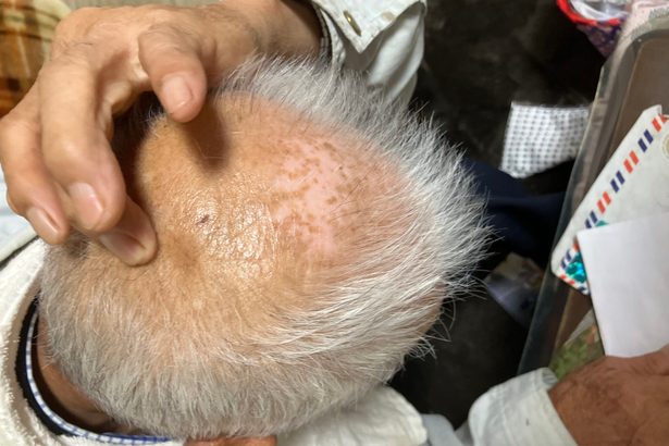 父にたたかれた傷　今も　福島の伊藤久夫さん（９１）　「集団自決」悲劇　南洋から沖縄へ続く