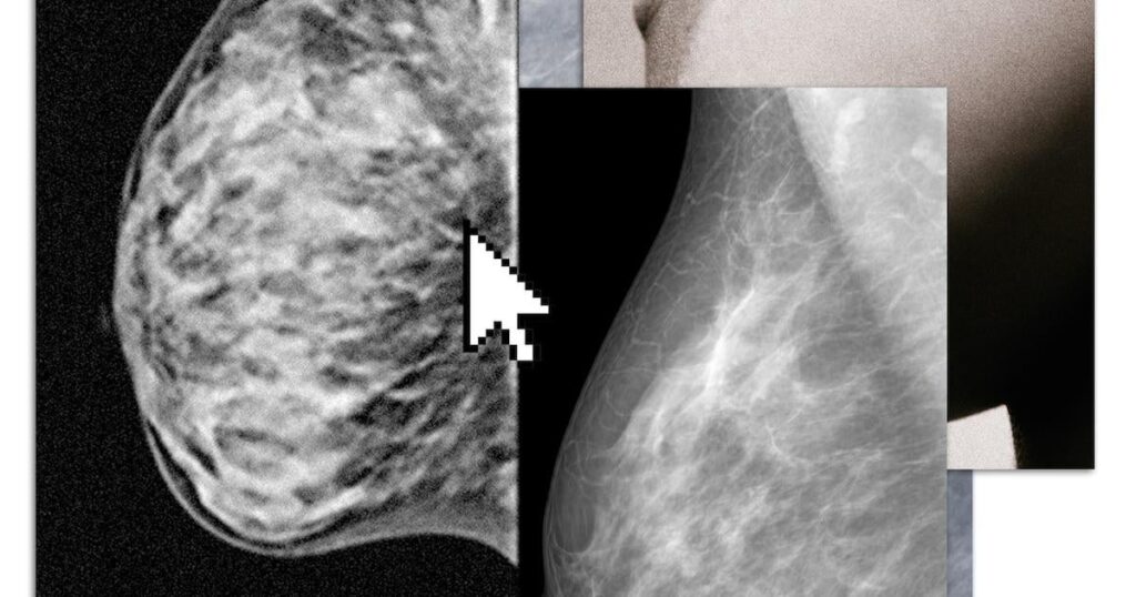 乳房密度の高い腫瘍を検出するための MRI はまだ利用できません。そこで女性自身が検査を求める