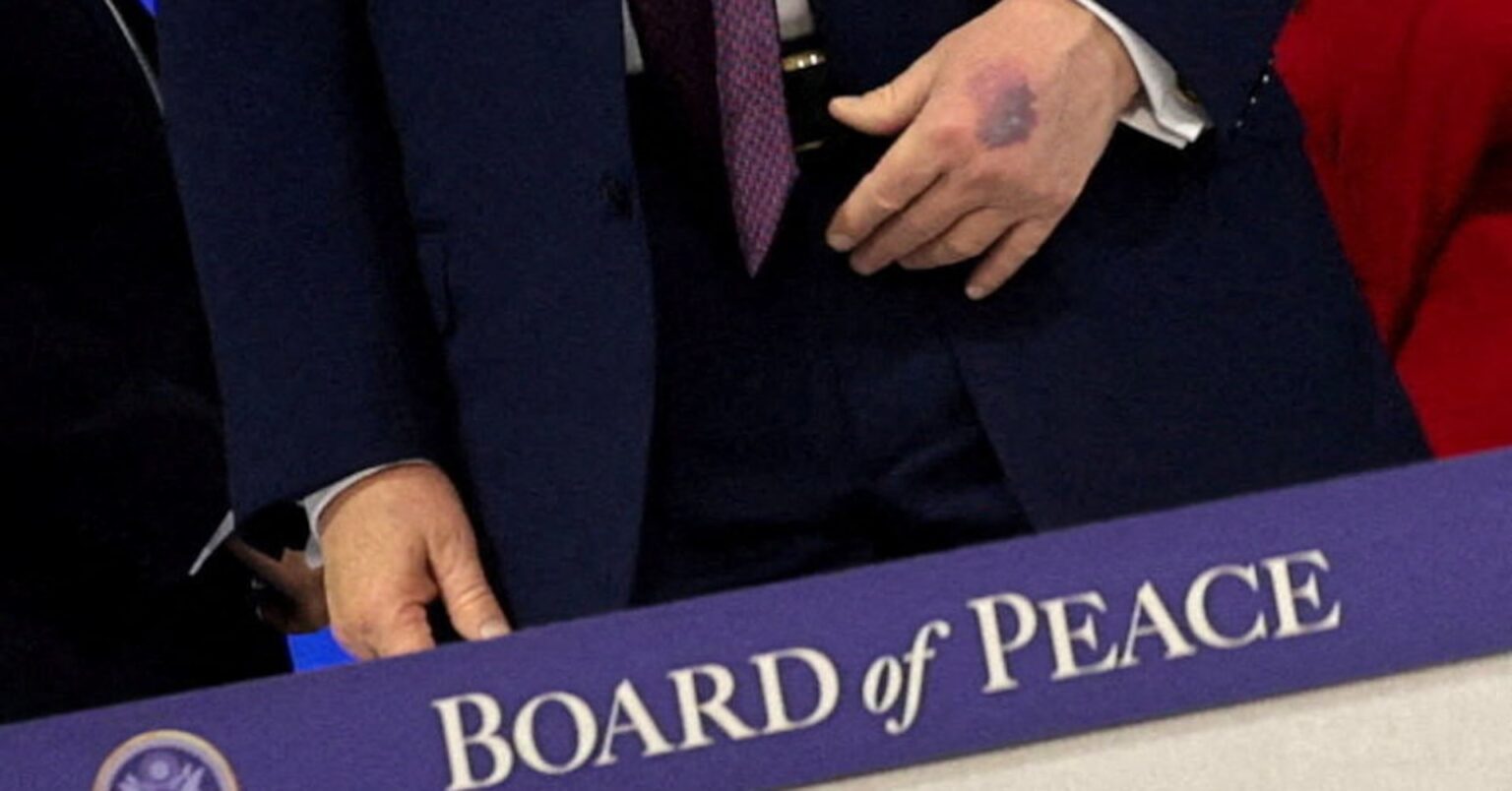 トランプ氏の手に新たなあざ、アスピリン服用が原因と説明 | ロイター