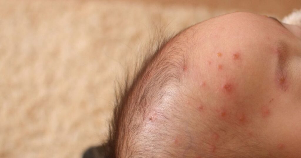 水ぼうそう流行、沖縄県が注意報　インフルエンザも継続