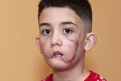 XLブリーに襲われた少年、事件で犬の飼い主と住宅団体を告訴