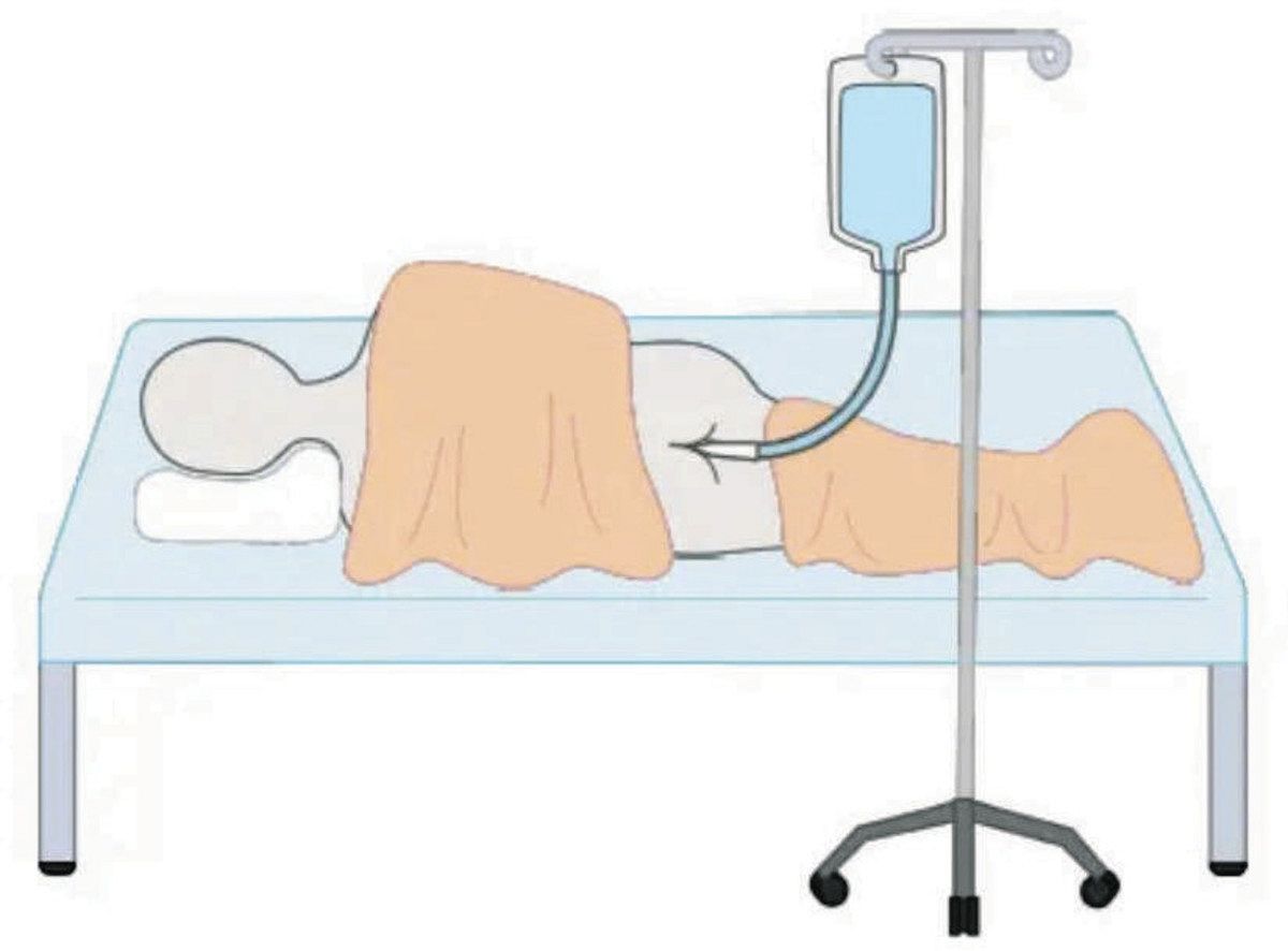 健康な成人男性を対象に、直腸から液体を投与した臨床試験のイメージ＝小高明日香さん作成
