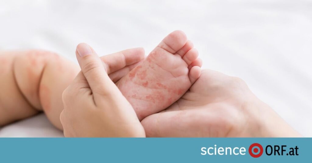 WHO：オーストリアはもはや公式には「麻疹撲滅国」ではない