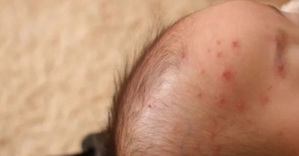 水ぼうそう「注意報」発令　那覇と中部保健所　沖縄