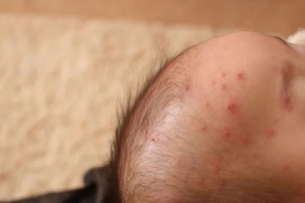 水ぼうそう「注意報」発令　那覇と中部保健所　沖縄