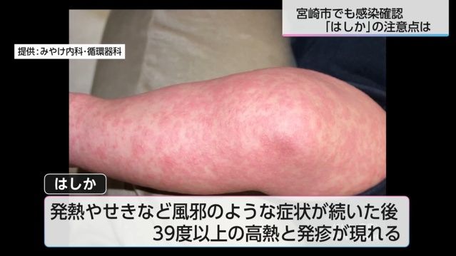 感染力はインフルエンザの約10倍!? 宮崎市で7年ぶりの「はしか」感染を確認 驚異の感染力から身を守るために今できること(2026年4月10日掲載)|UMK NEWS NNN 共有