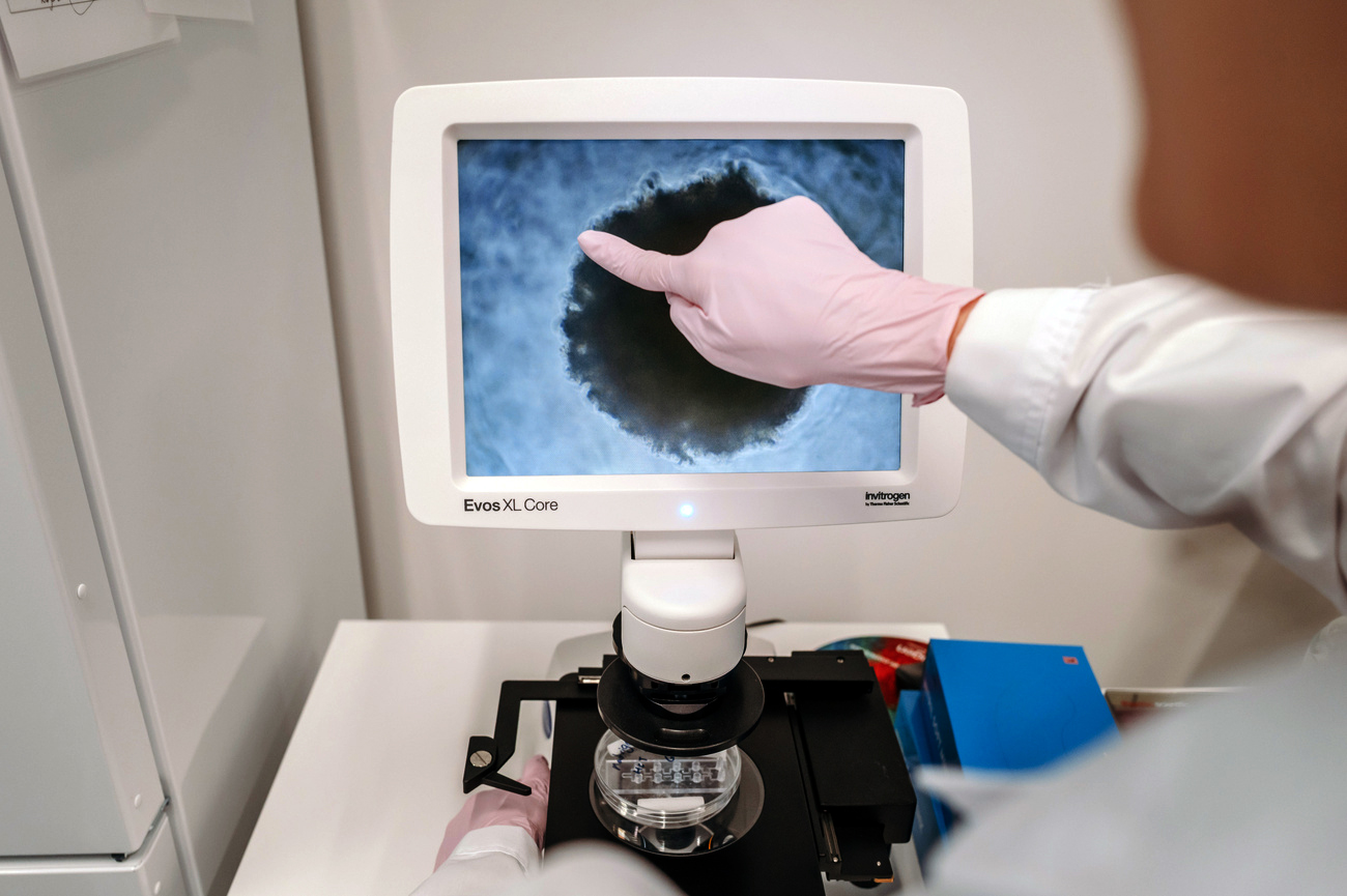 大腸がん細胞の顕微鏡スクリーン。