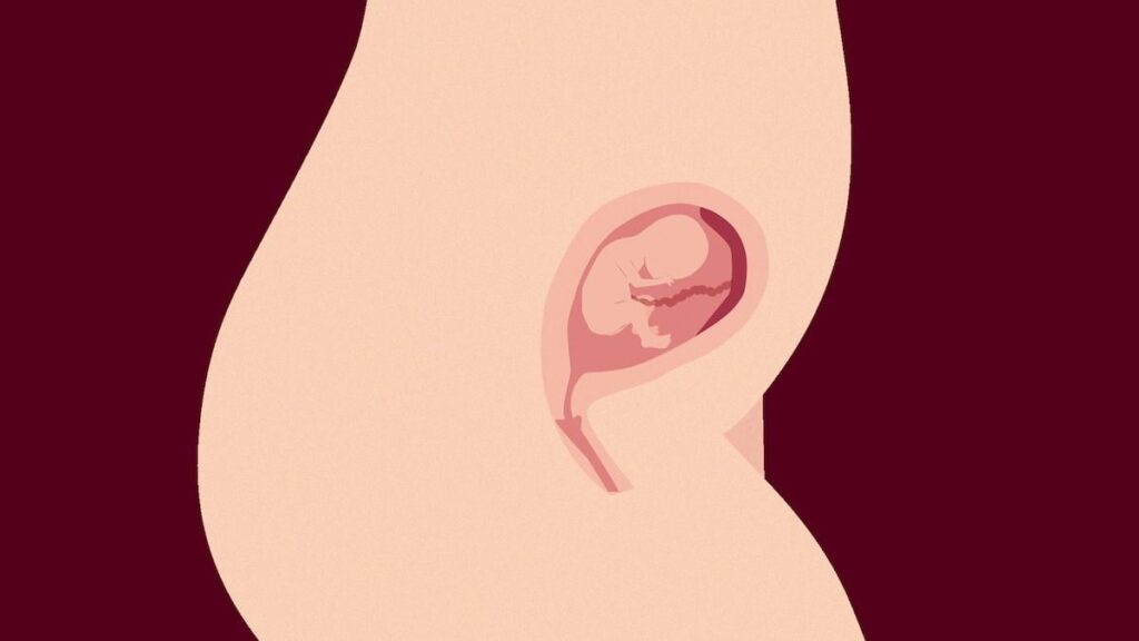 昨年中絶制限が変更されてから、後期中絶を受ける人が大幅に増加