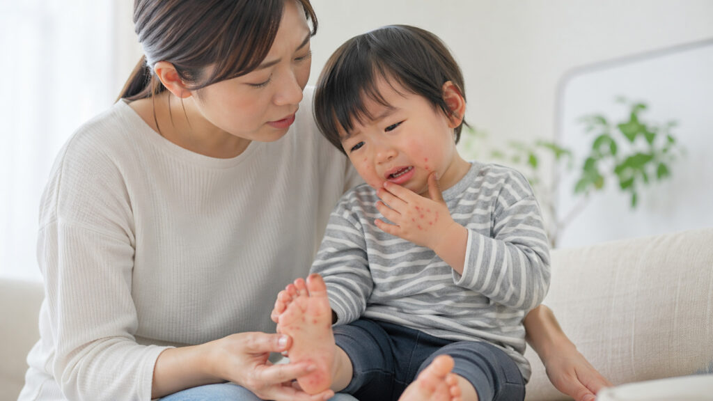 宮崎で手足口病が警報レベルに　現時点の最新公式情報を整理ー画像2