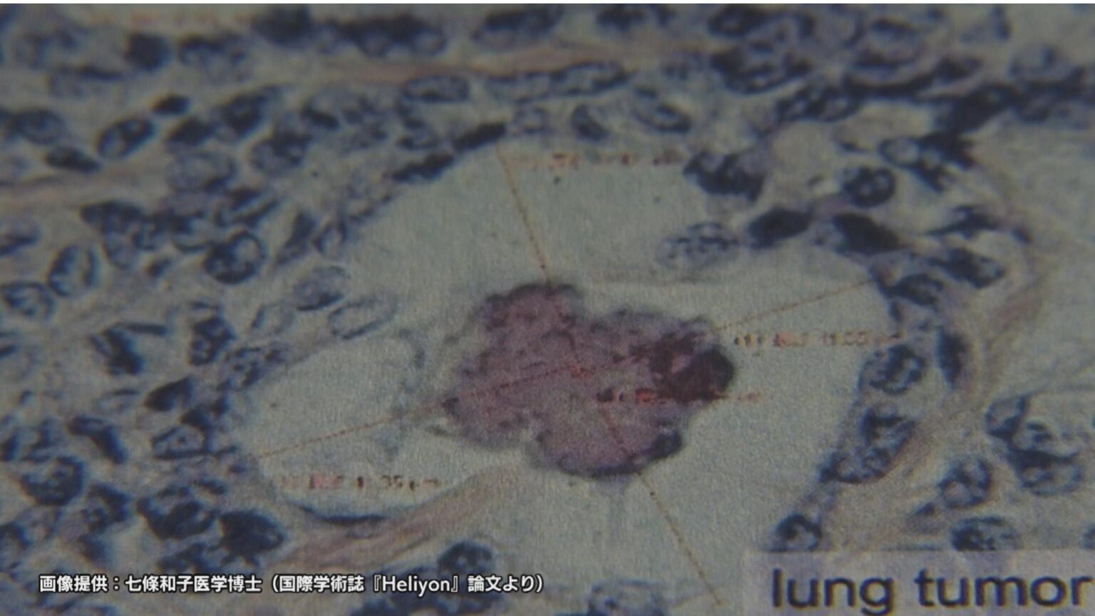 広島原爆の入市被爆者　70年後の体内からウラン検出　肺がん組織では「デスボール」確認　長崎大学研究グループ（NBC長崎放送） - Yahoo!ニュース